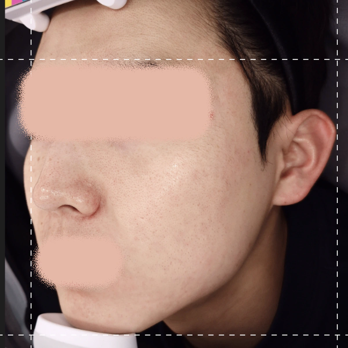 Photo after acne therapy treatment