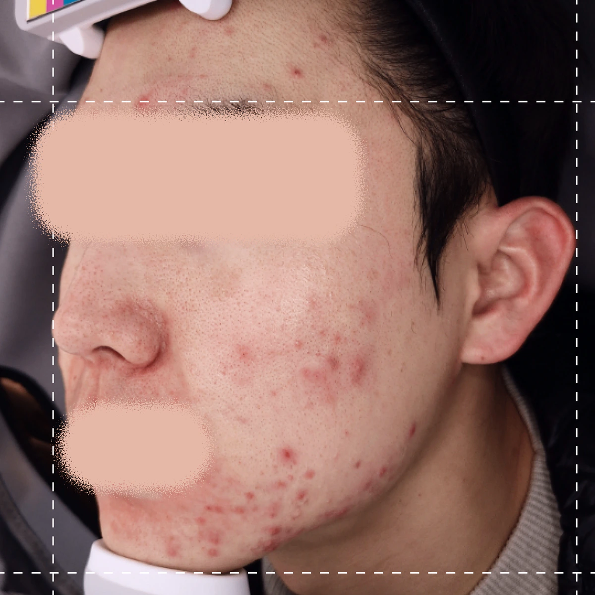 Before photo of acne therapy treatment