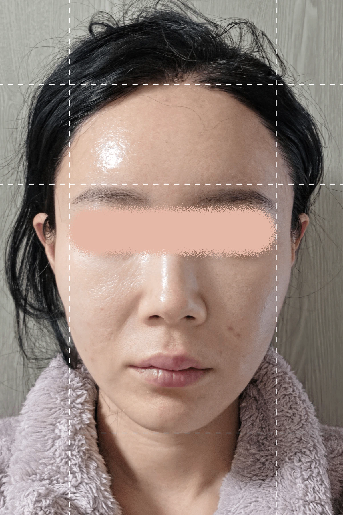 Photo taken immediately before the thread sculpting treatment