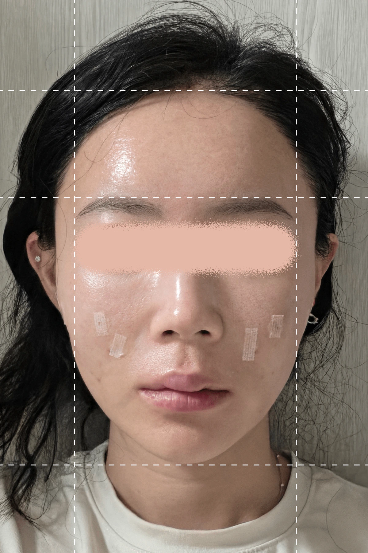 Photo taken immediately after thread sculpting treatment