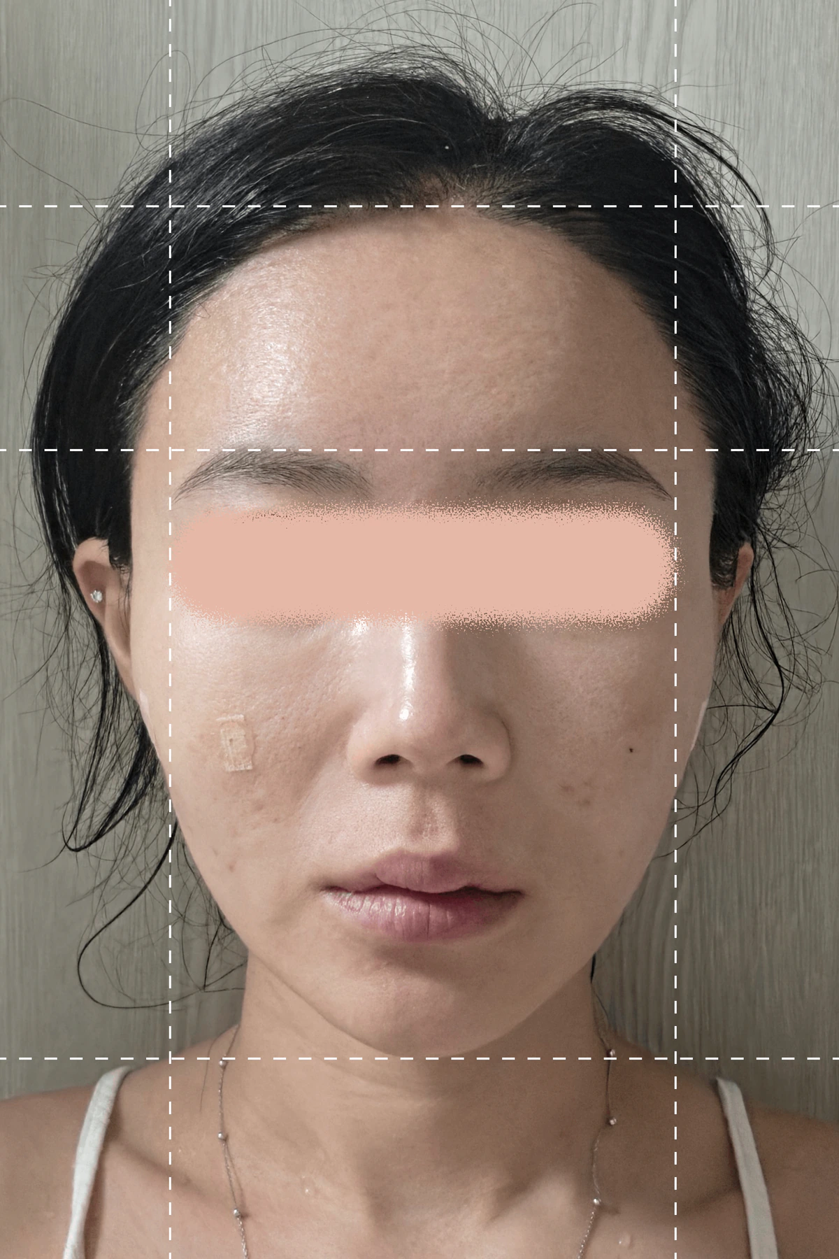 Photo taken 1 week after thread sculpting treatment