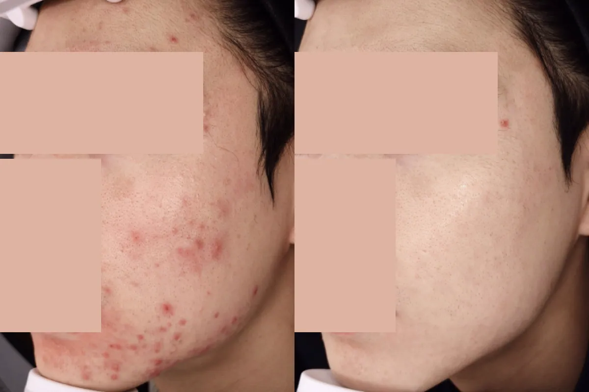 Before and after photos of severe pustular acne therapy
