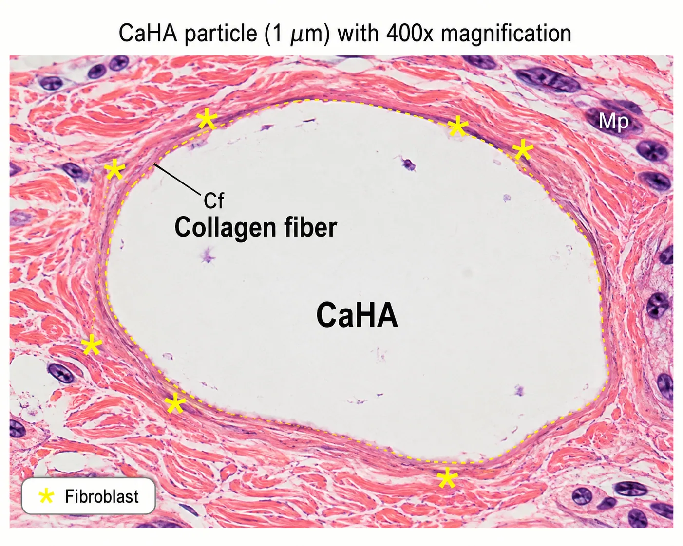 Dual action of immediate volume and collagen production