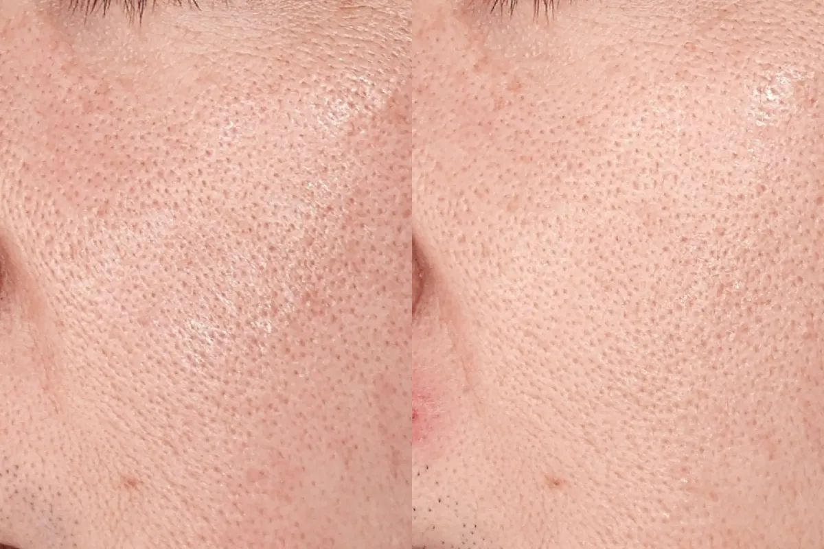 Before and after photos of pore therapy