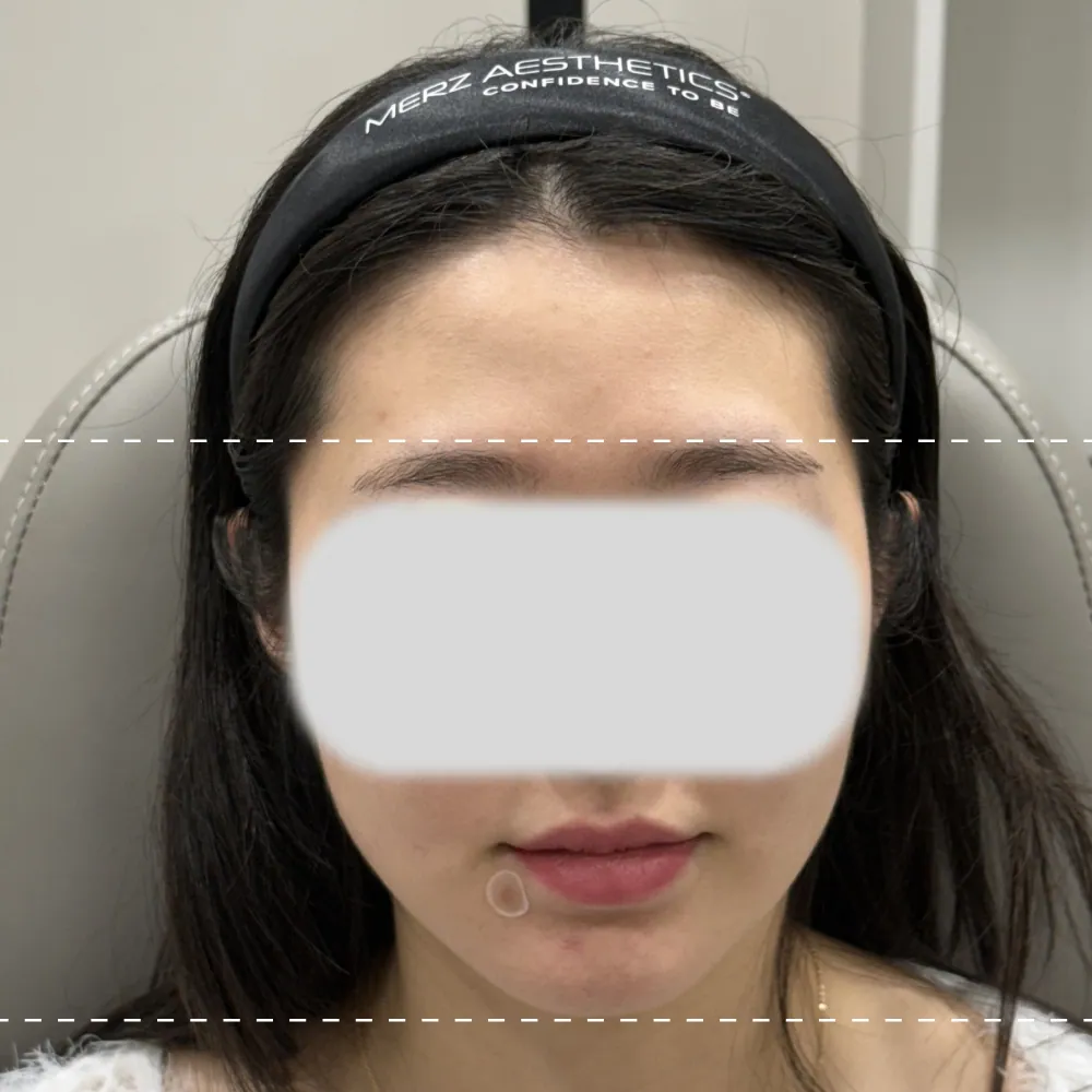 Before forehead filler treatment