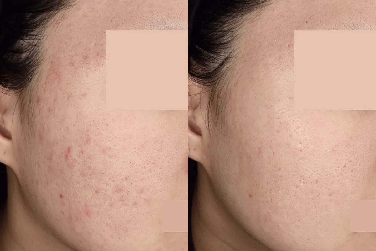 Before and after photos of mild pustular acne treatment