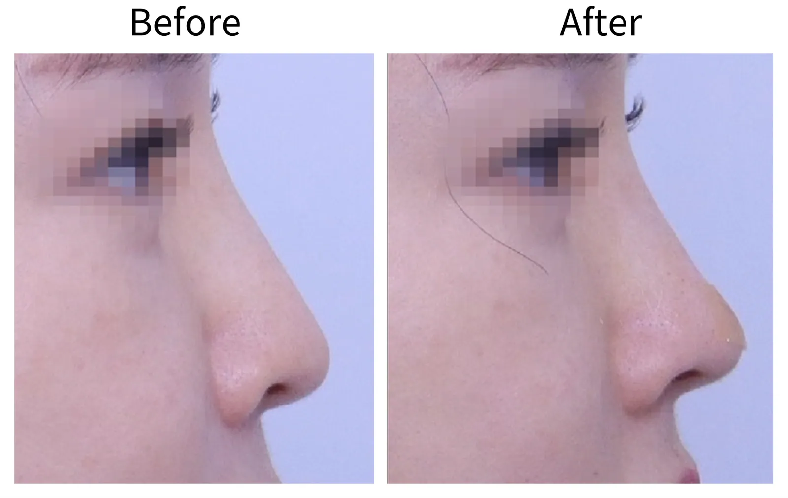 Comparison photos of the side profile before and after LSCO treatment