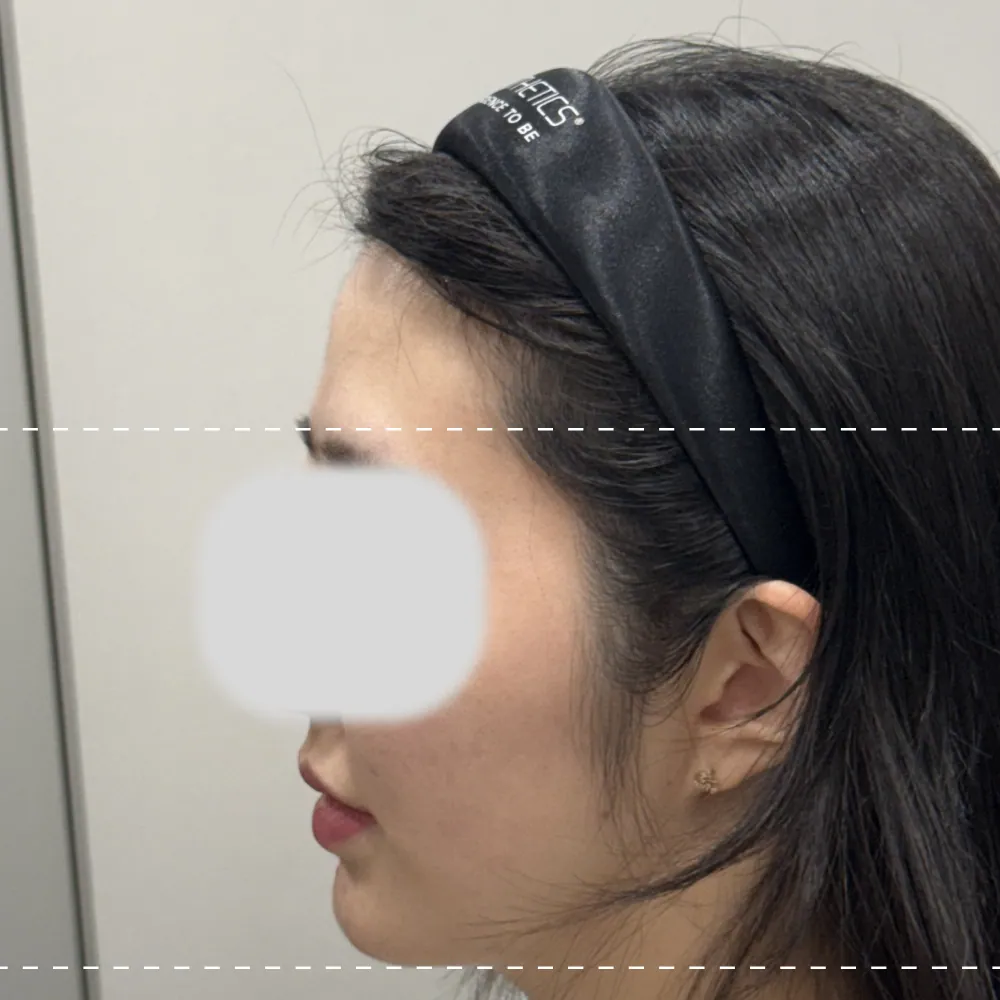 Forehead filler left 90-degree angle before treatment
