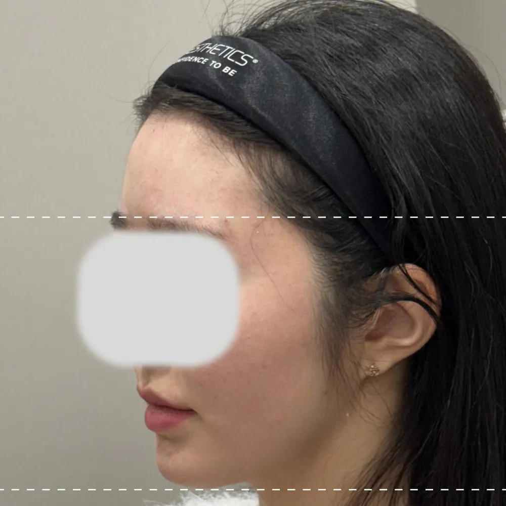 After forehead filler treatment on the left side (90 degrees)