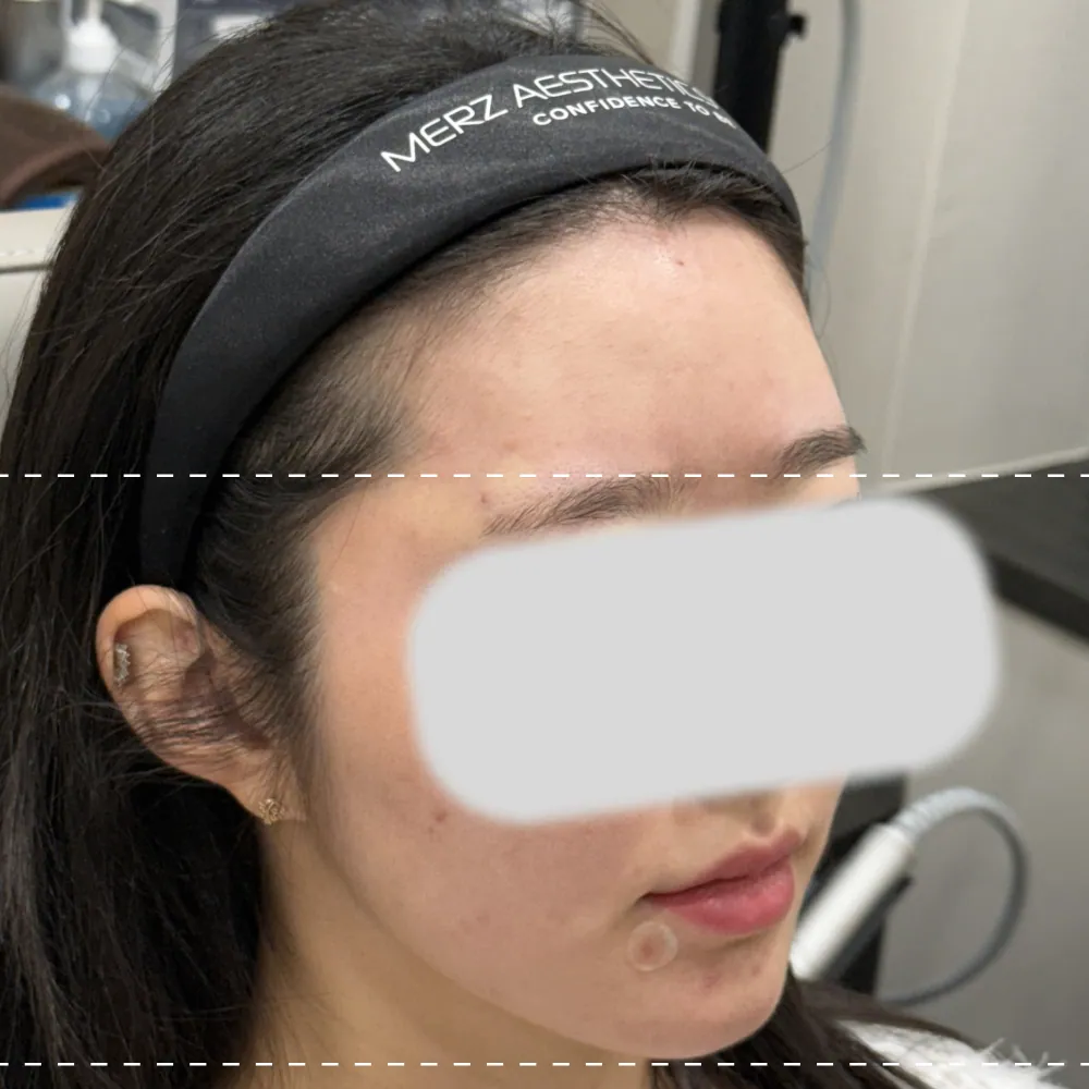 After forehead filler treatment on the right side at a 45-degree angle