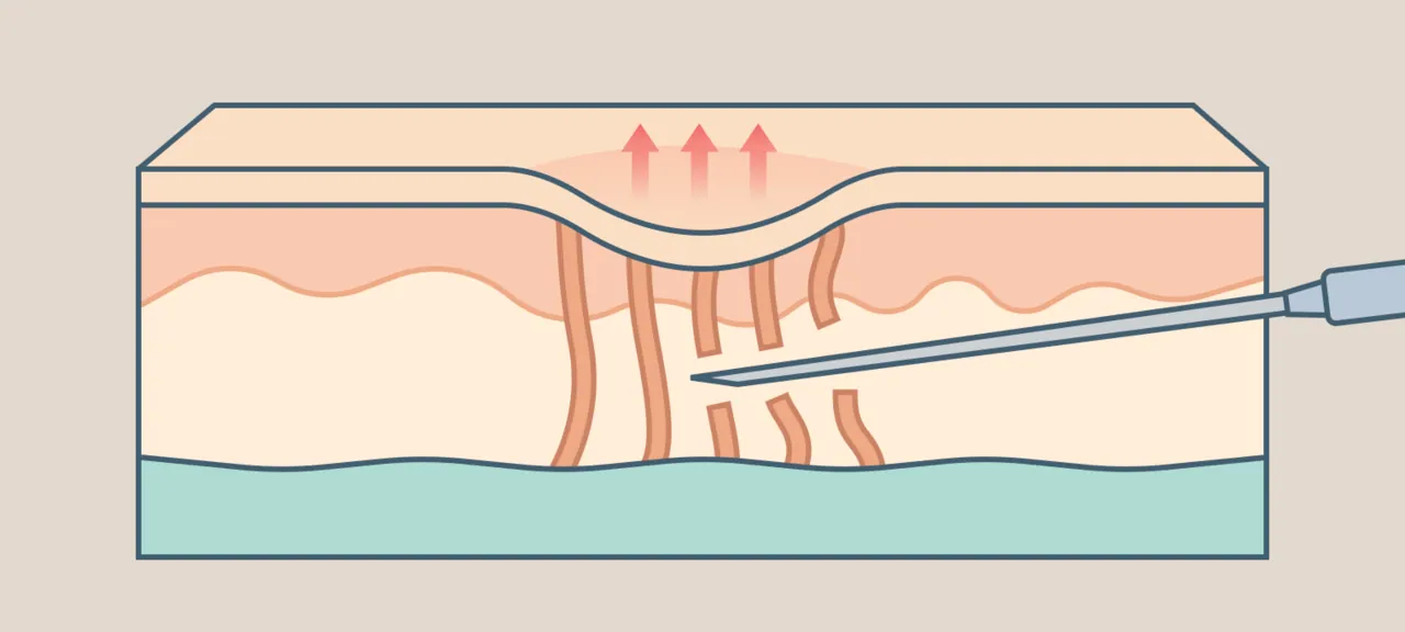 Subcision