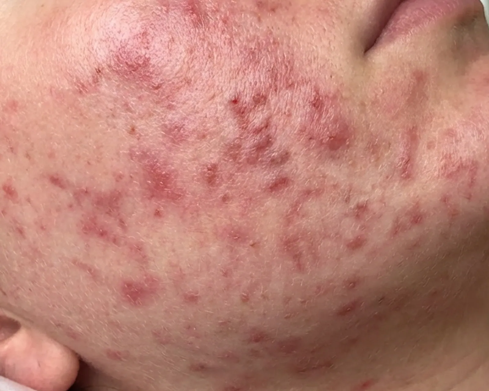 Post-inflammatory pigmentation