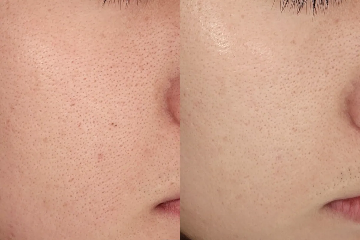 Pigmentation therapy before and after photos