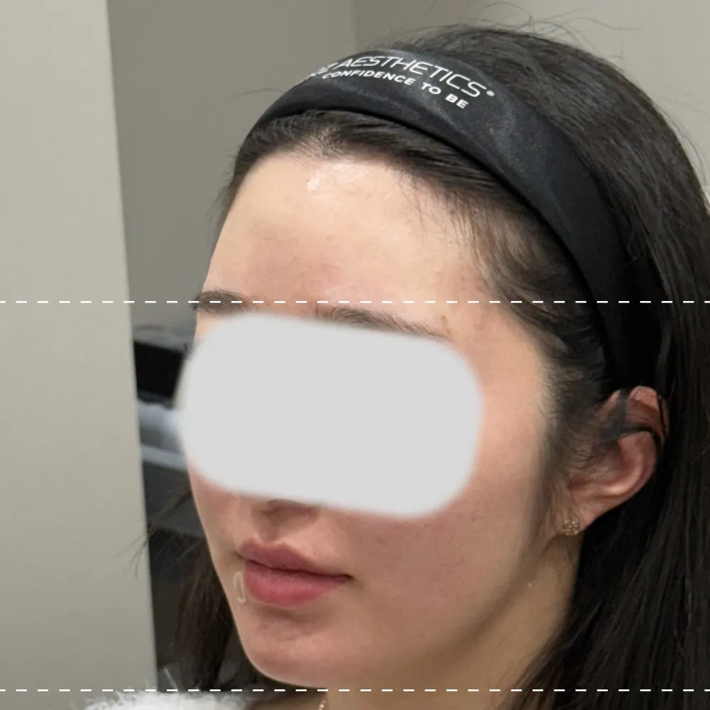 After forehead filler treatment at a 45-degree angle on the left