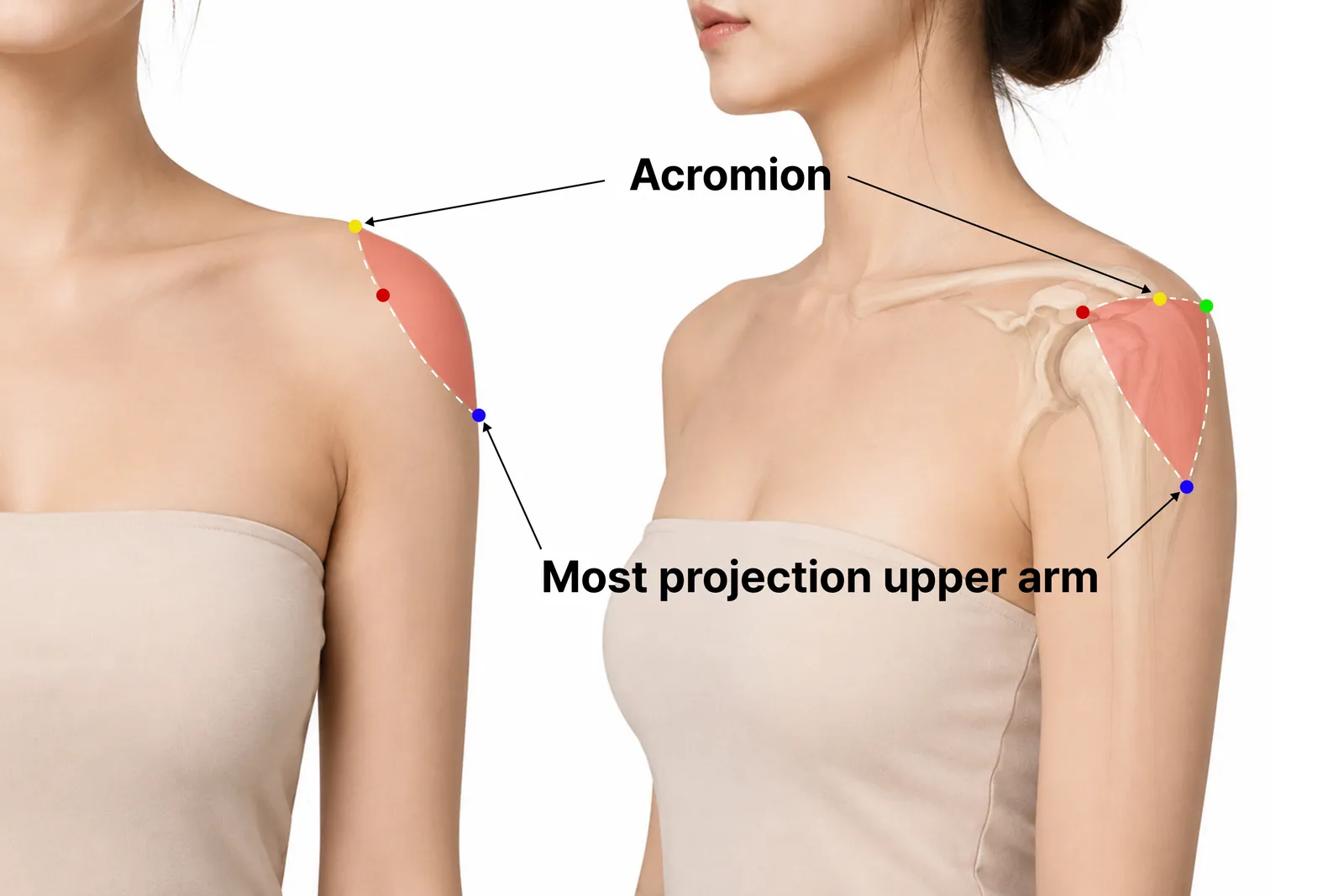 Right-angle shoulder filler treatment area