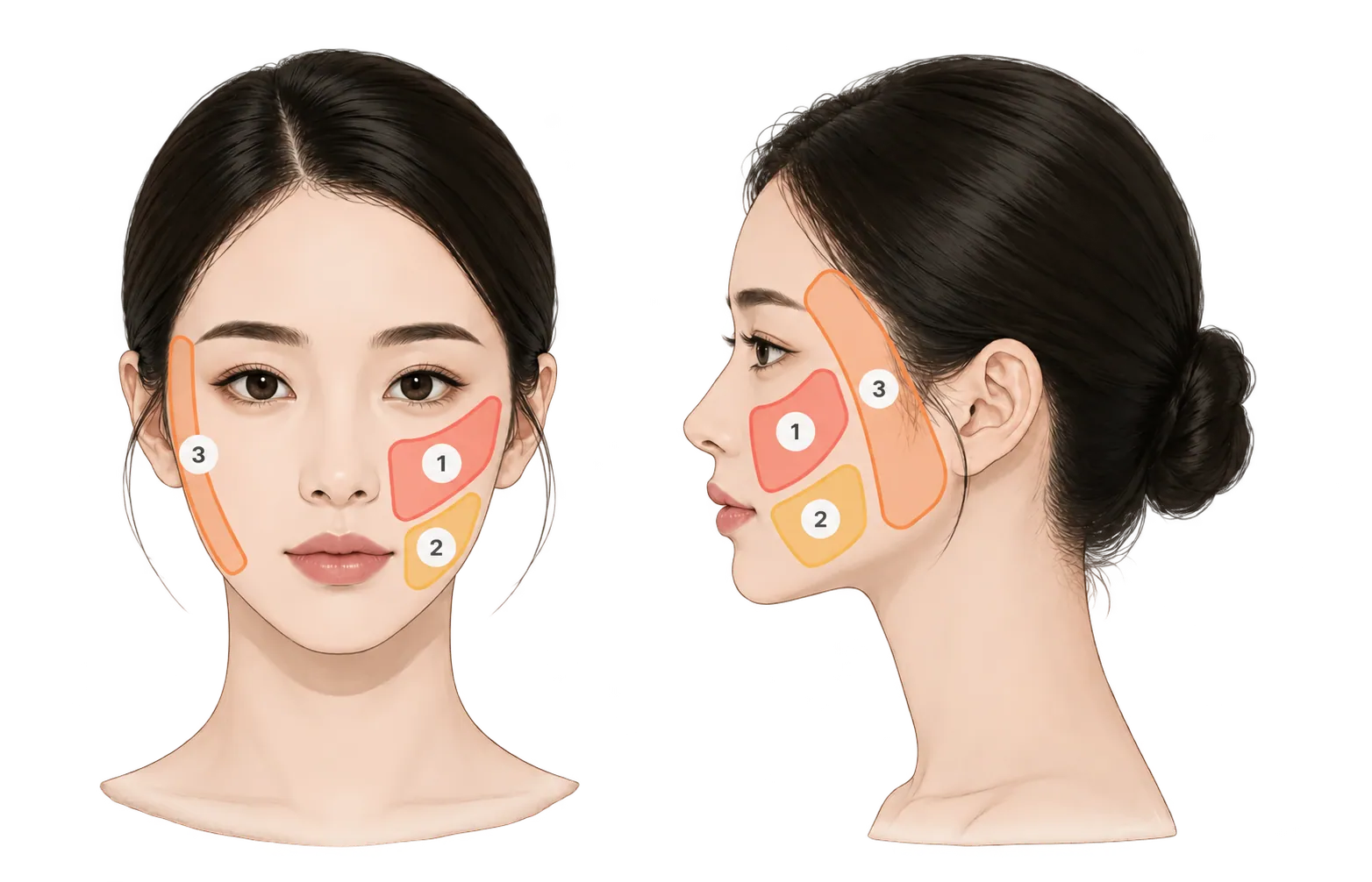 Doussil treatment areas: nasolabial folds, marionette lines, side cheek lines