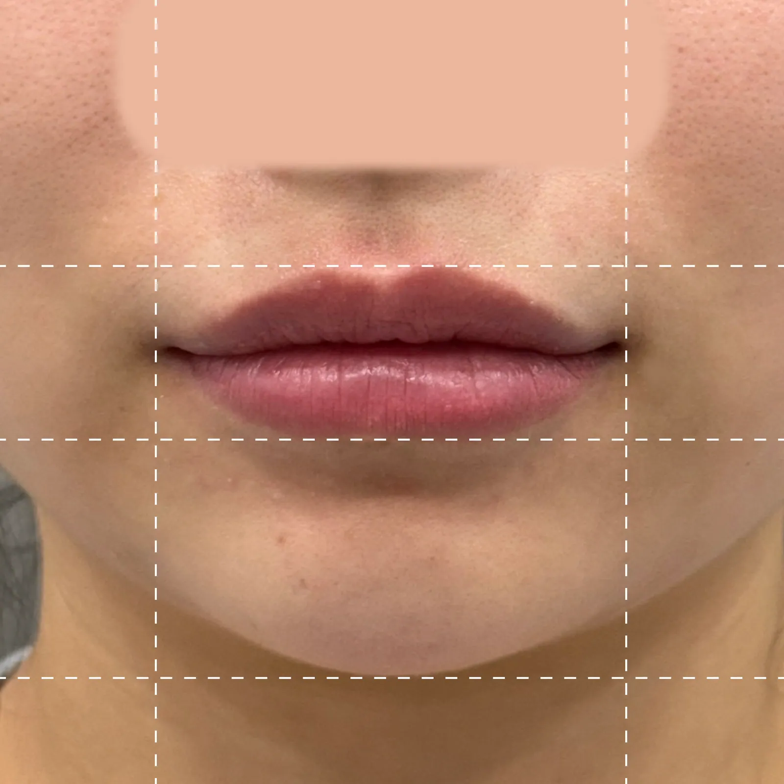 Before lip filler treatment from the front