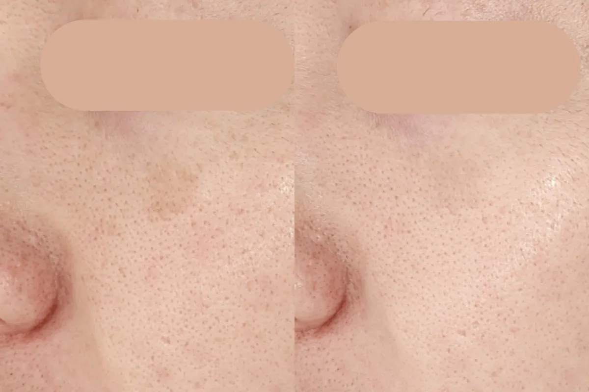 Pigmentation therapy before and after photos