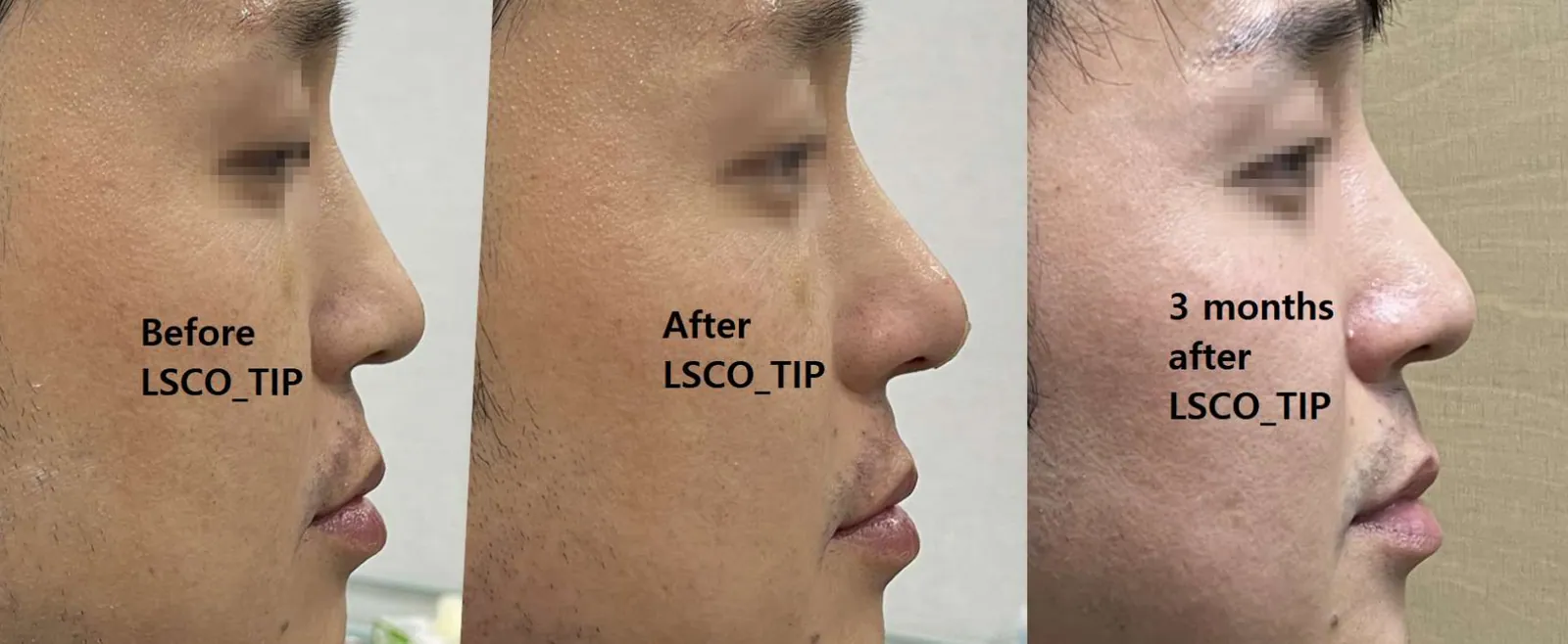 Comparison photos of the side profile before, immediately after, and 3 months after LSCO nose tip treatment