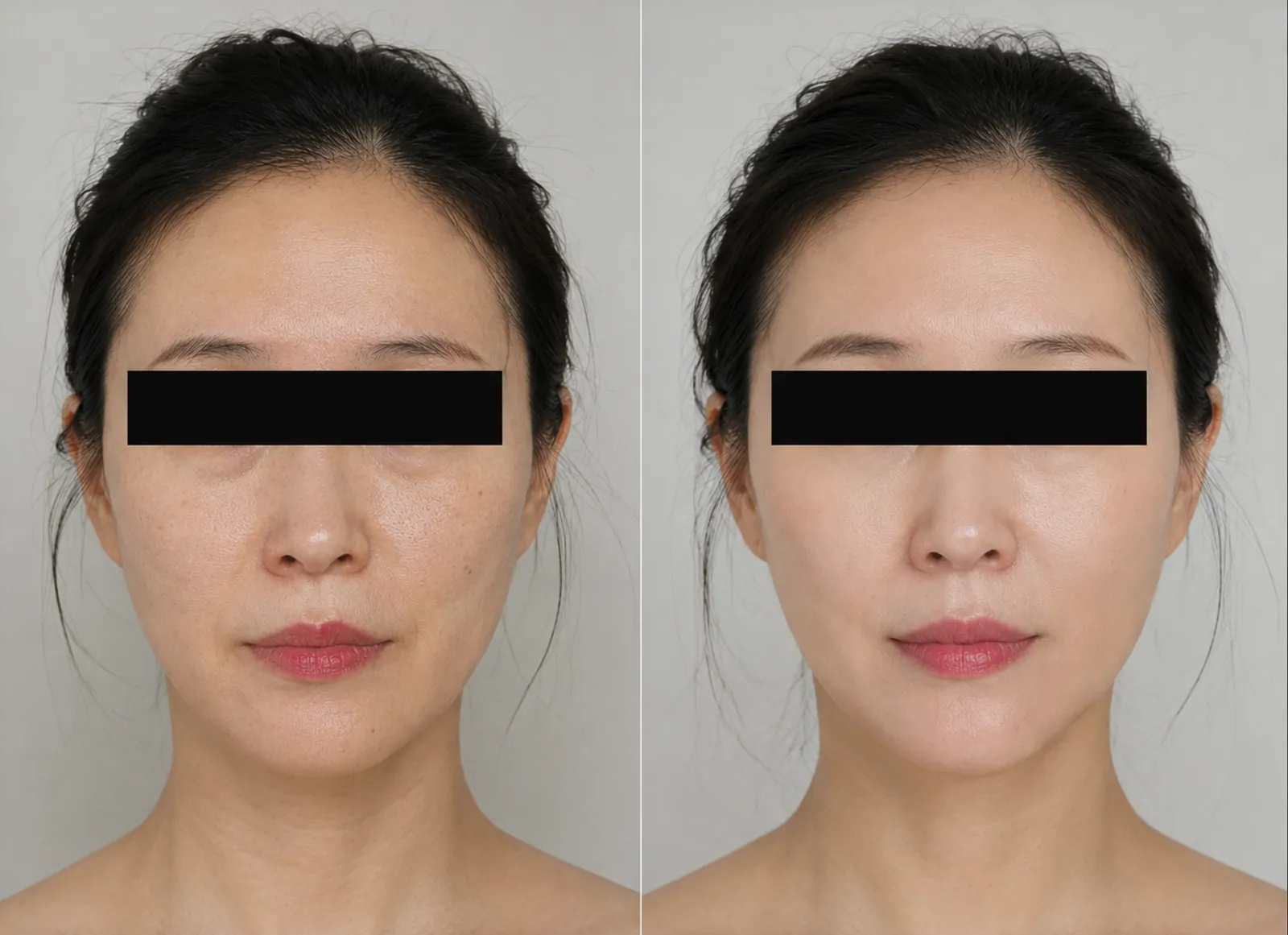 Before and after wrinkle reduction treatment