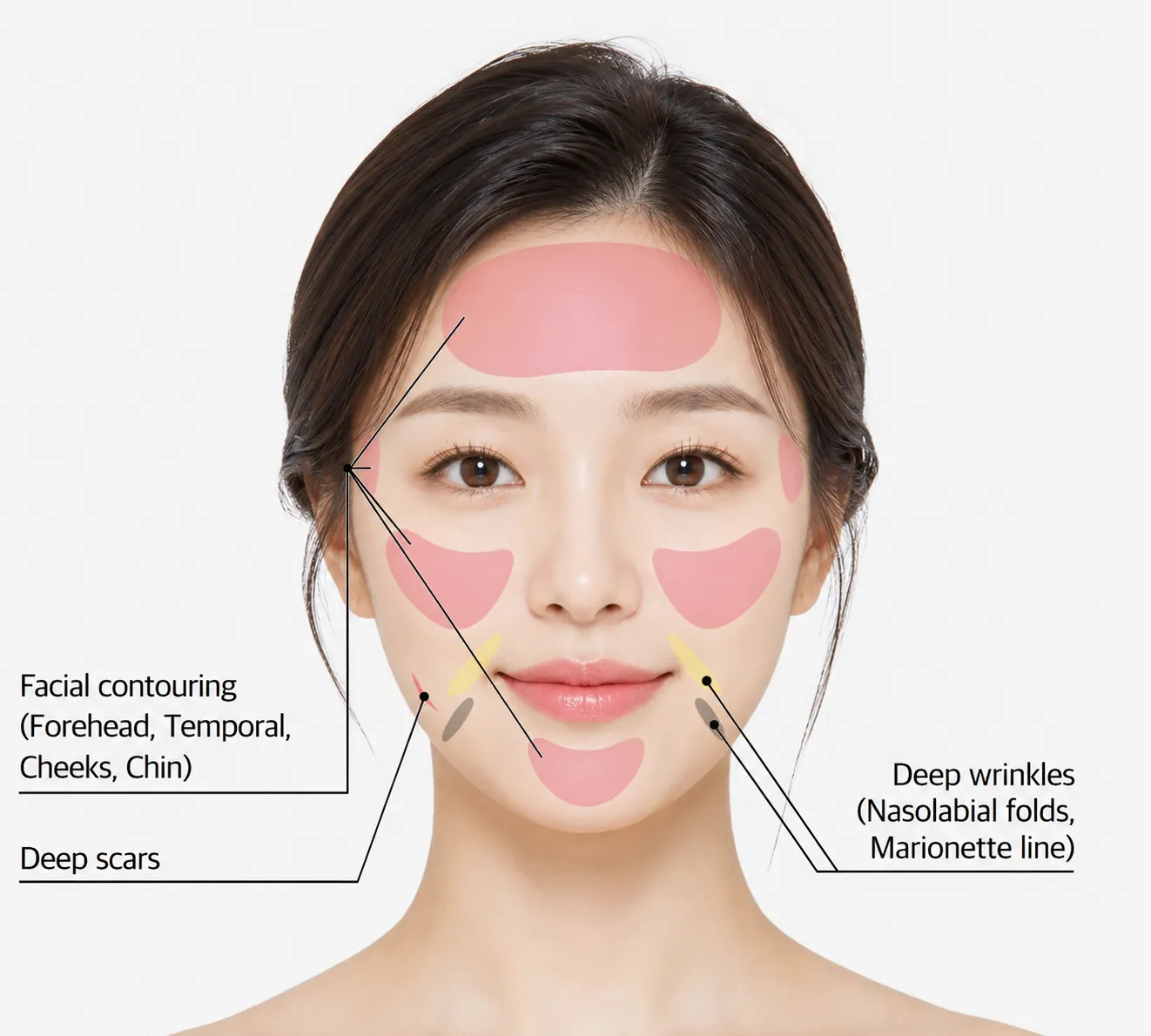 Juvelook volume treatment area