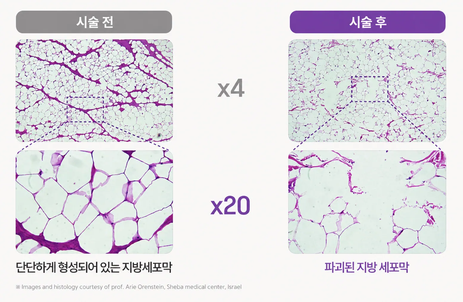 Comparison of fat cell membranes before and after the treatment