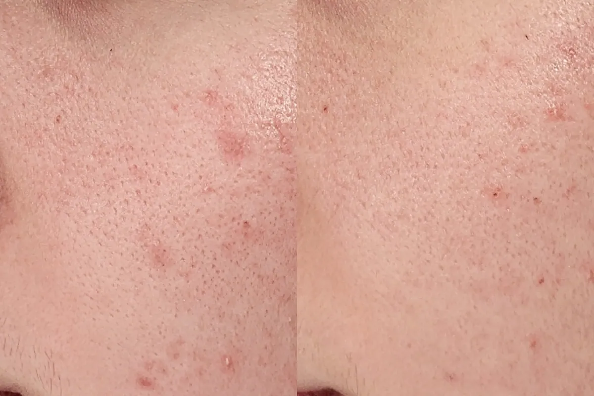 Before and after photos of pore therapy