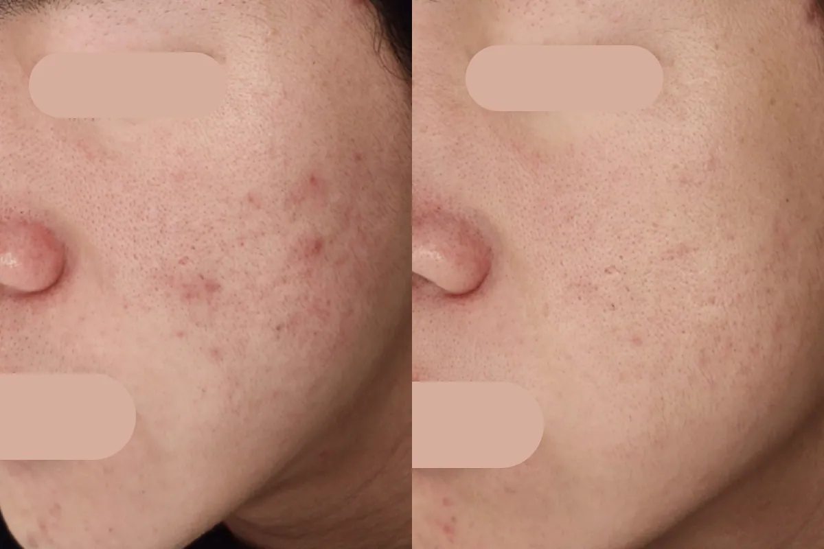 Pigmentation therapy before and after photos