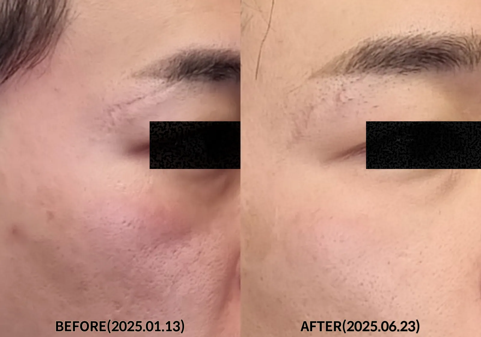 Deep Skin Regeneration Therapy 2 Sessions (2025.01 ~ 2025.06) Before & After Photos