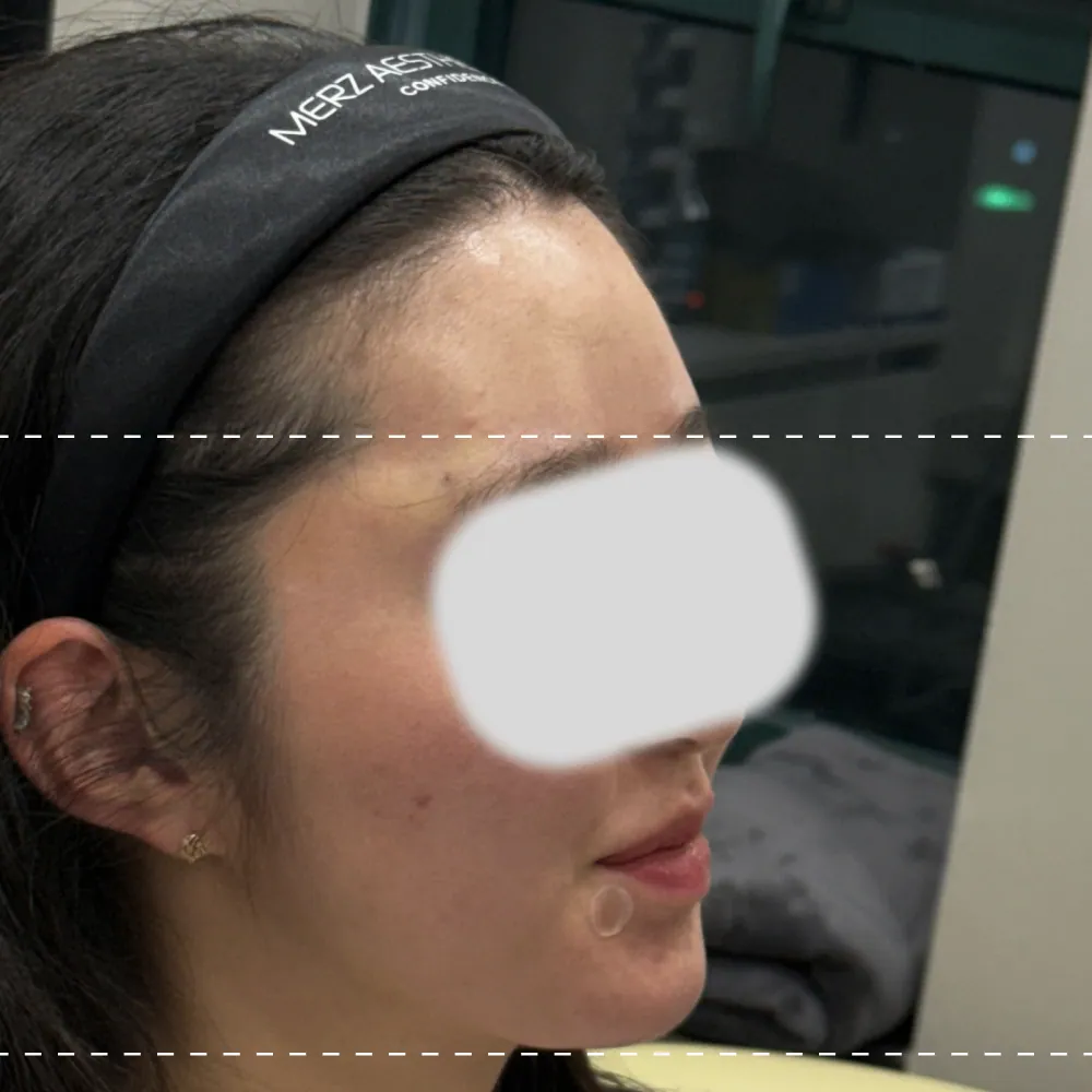After forehead filler treatment on the right side (90 degrees)