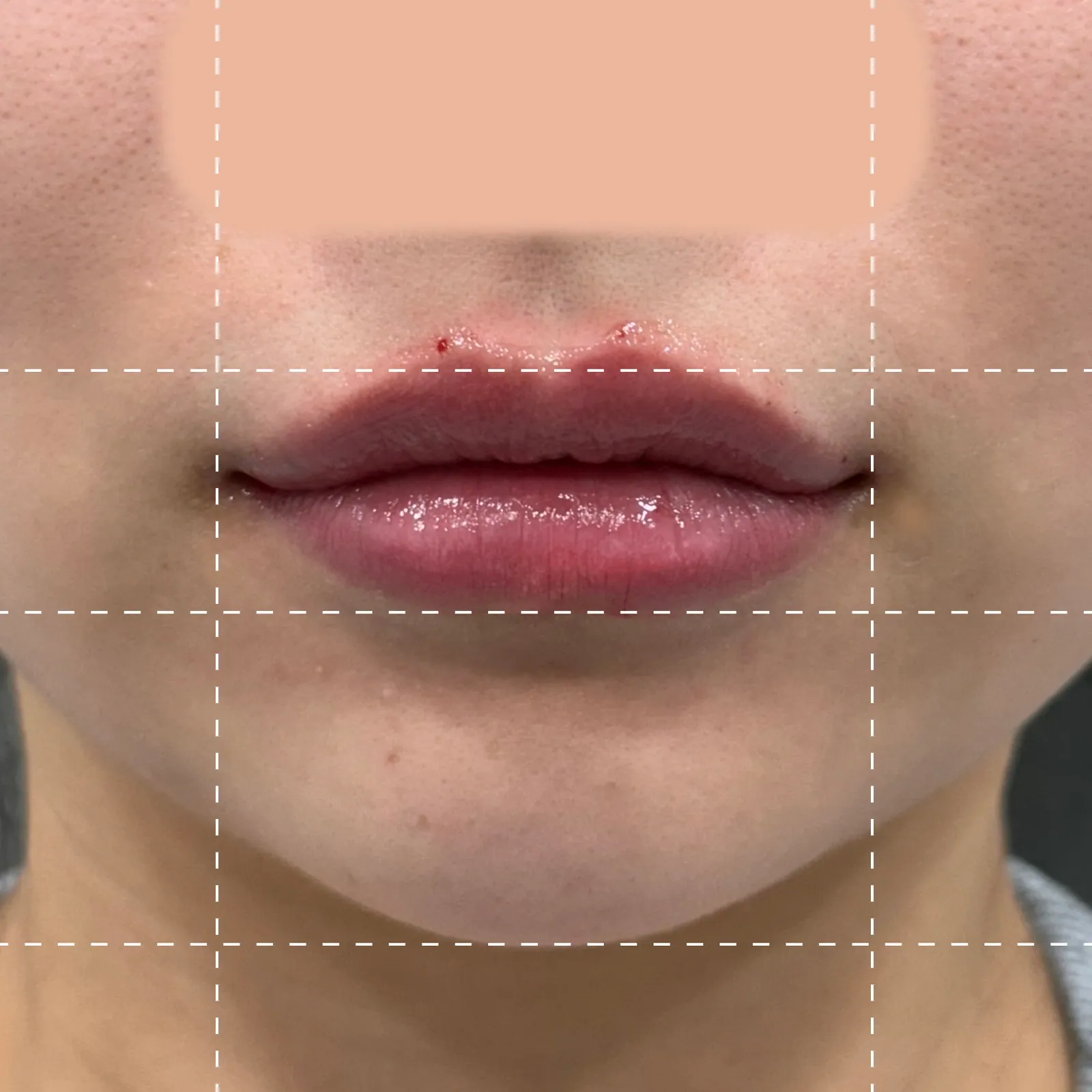 After lip filler treatment from the front