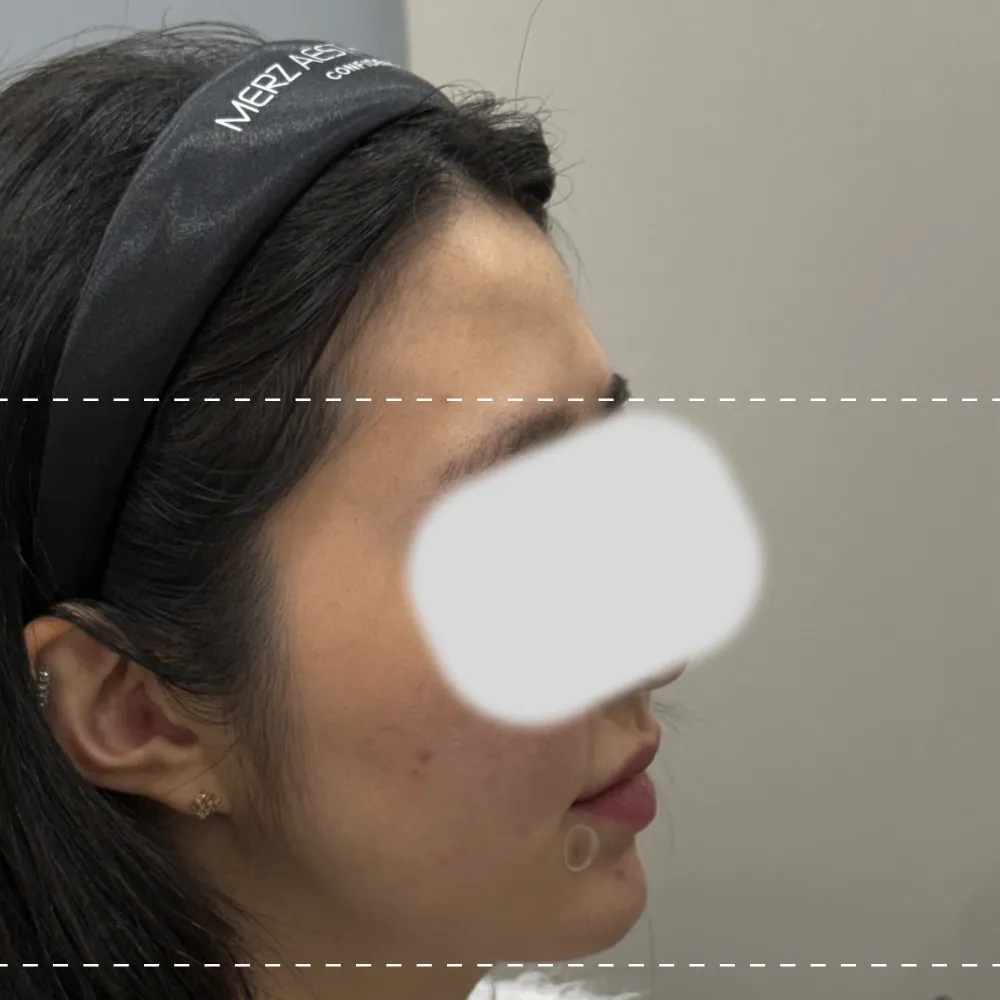Forehead filler, right side, 90 degrees before treatment