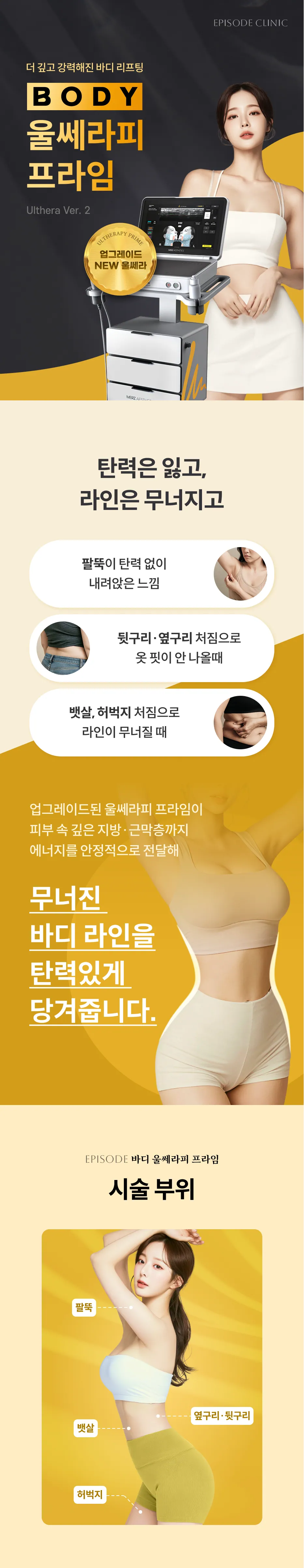 Body Ulthera Prime Detailed Guide: Ulthera Ver.2 Upgrade, Areas of Concern (Upper arms, flanks and sides, belly fat and sagging thighs), treatment Area Illustrations (Upper arms, flanks and sides, belly fat, thighs)