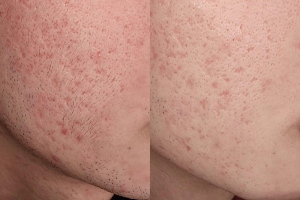 Before and after photos of red scar new skin therapy