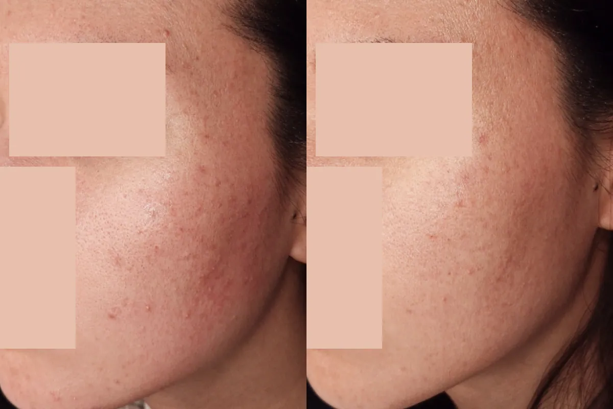 Before and after photos of comedonal acne therapy
