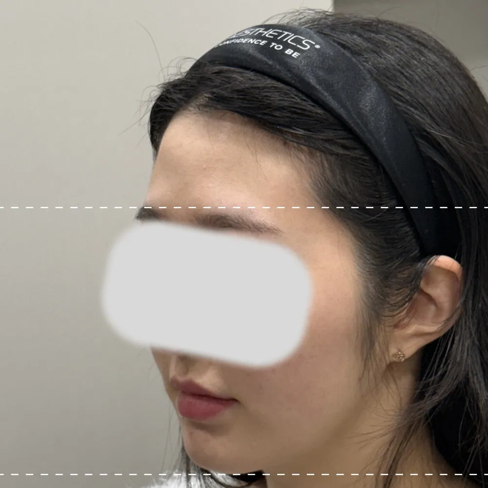 Forehead filler left 45-degree angle before treatment