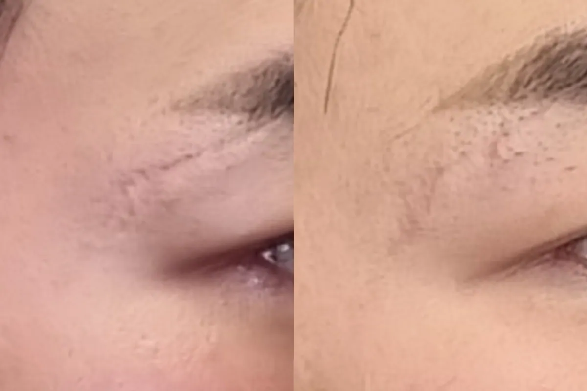 Before and after photos of basic scar new skin therapy