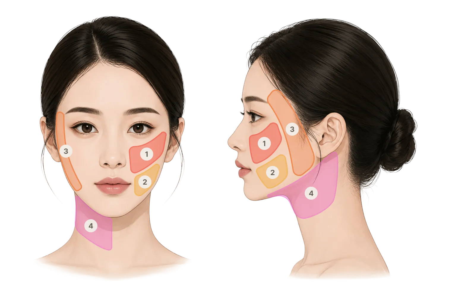 Thread sculpting treatment area