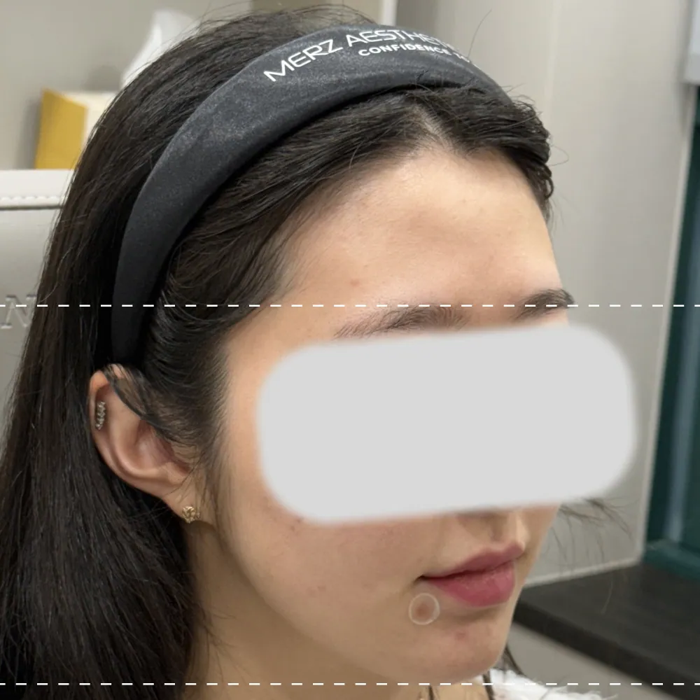 Forehead filler on the right side at a 45-degree angle before the treatment
