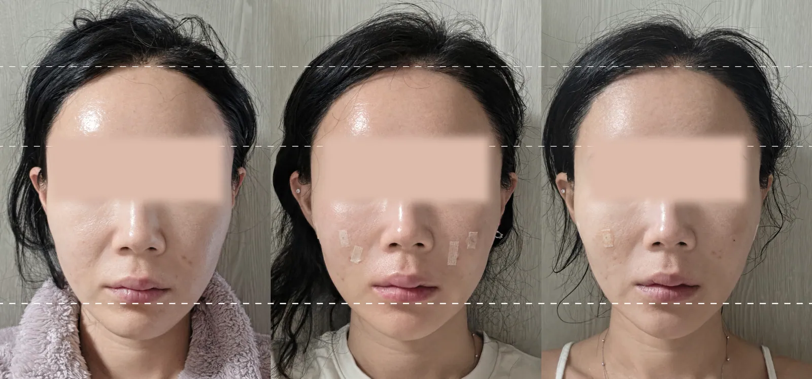 Silsculpting before and after photos