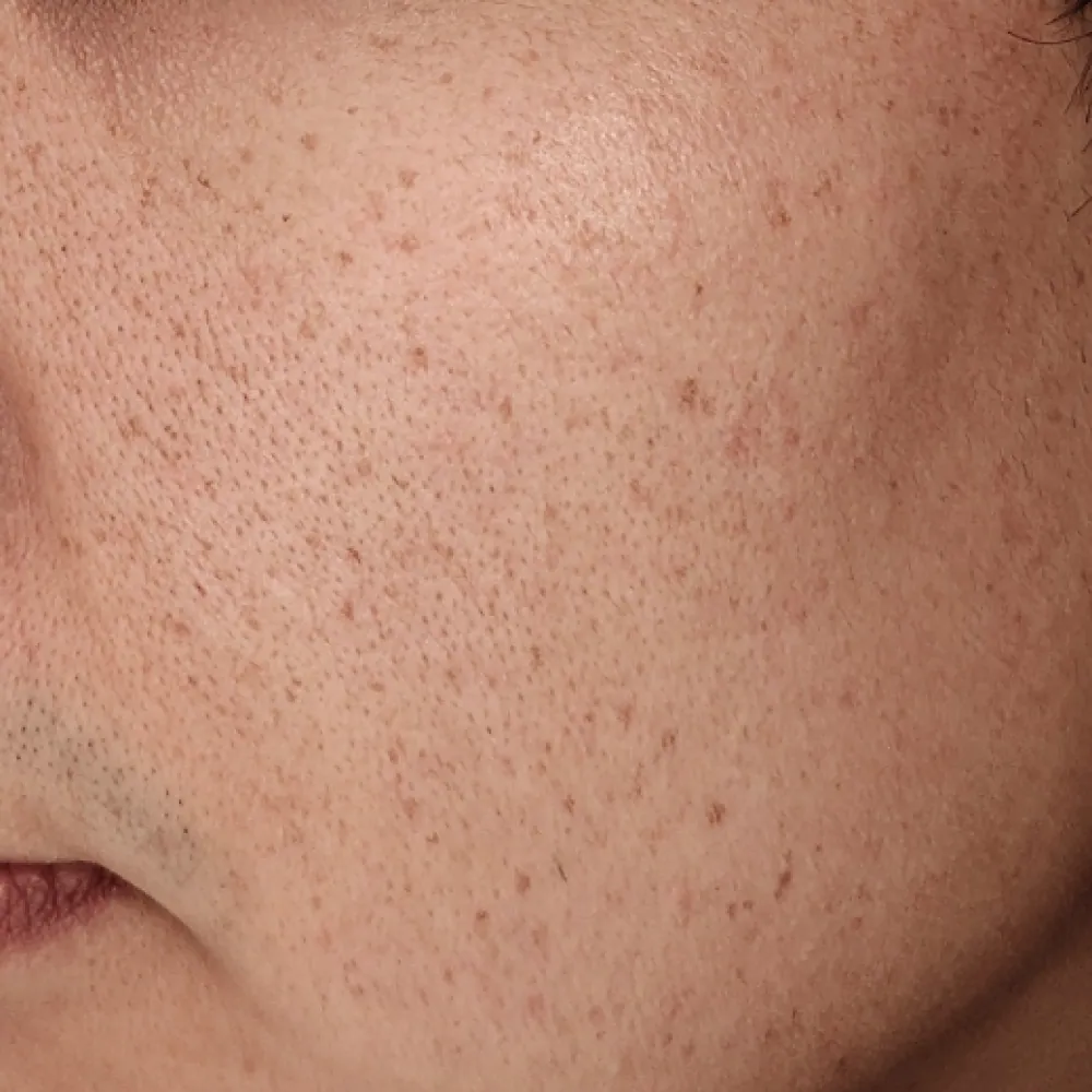 blemishes