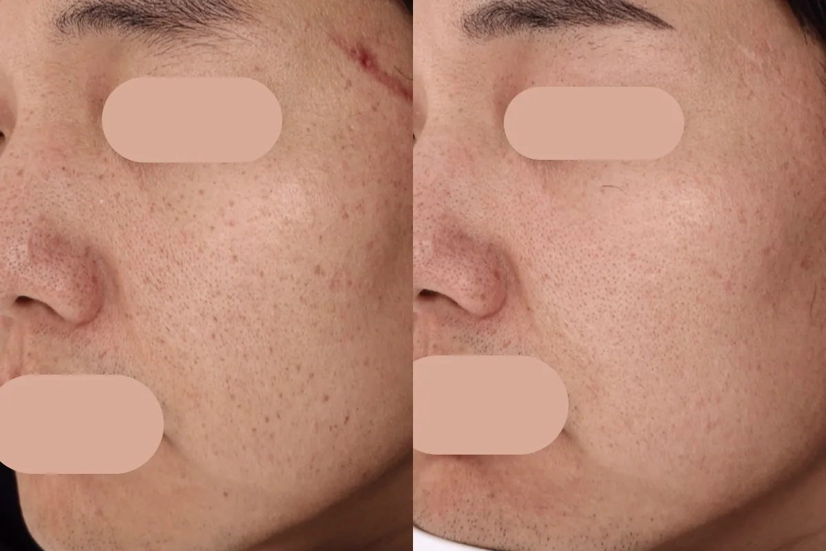 Pigmentation therapy before and after photos
