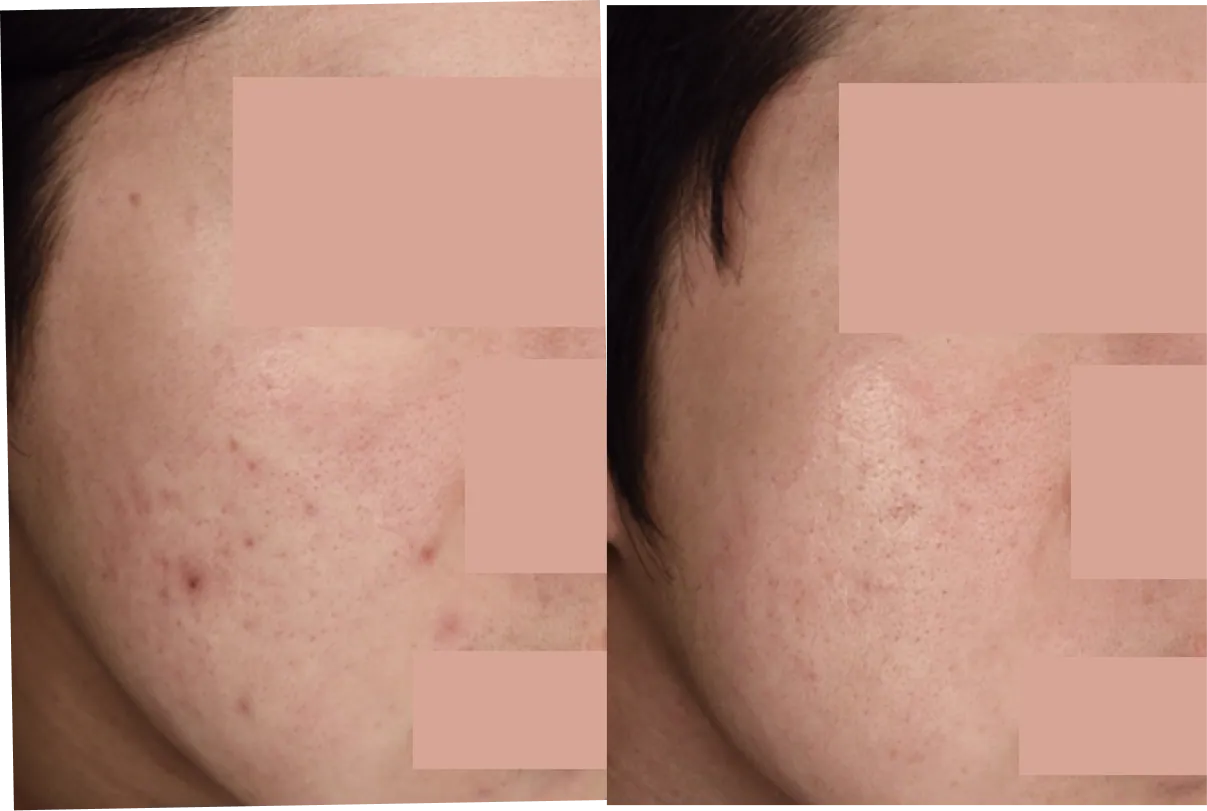 Before and after photos of mild pustular acne treatment