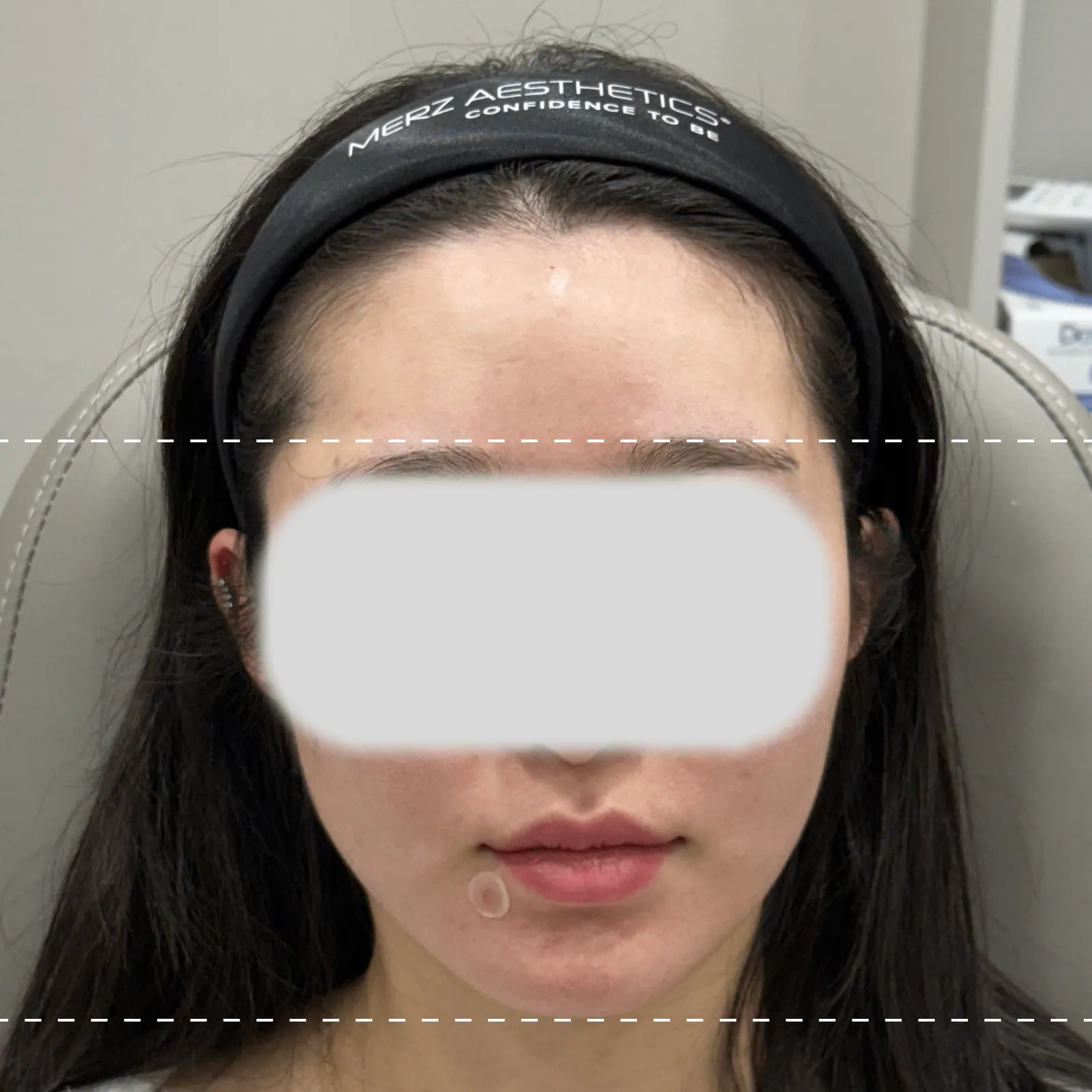 After forehead filler treatment on the front
