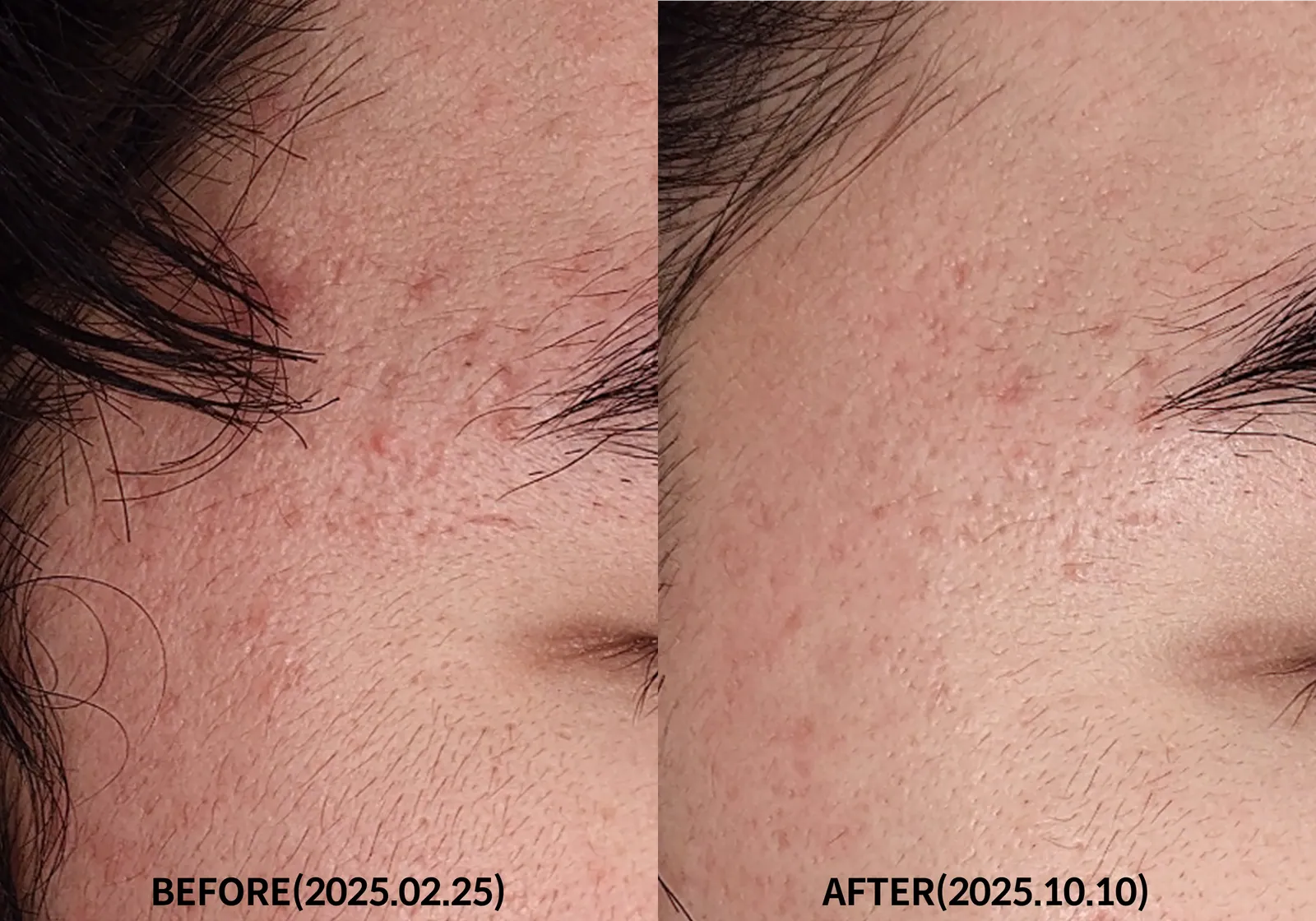 Skin Regeneration Therapy 3 Sessions (February 2025 – October 2025) Before & After Photos