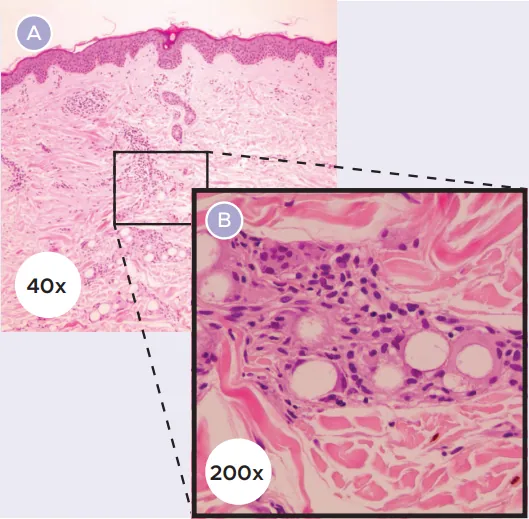 The process of replacing CMC gel volume with collagen volume